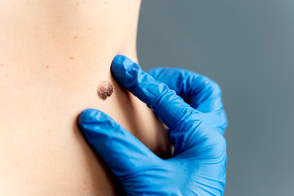 prevención primaria melanoma